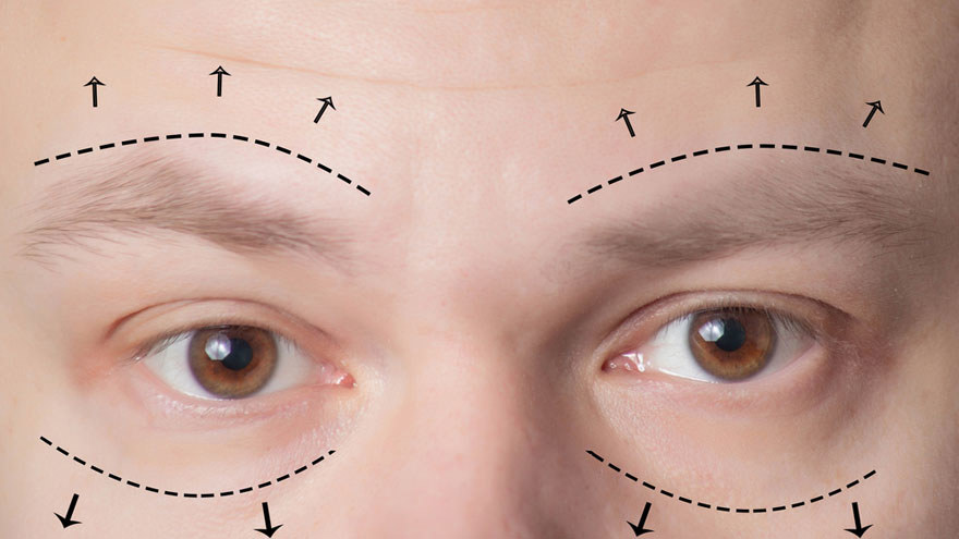 Men Are Getting Eyelid Surgery