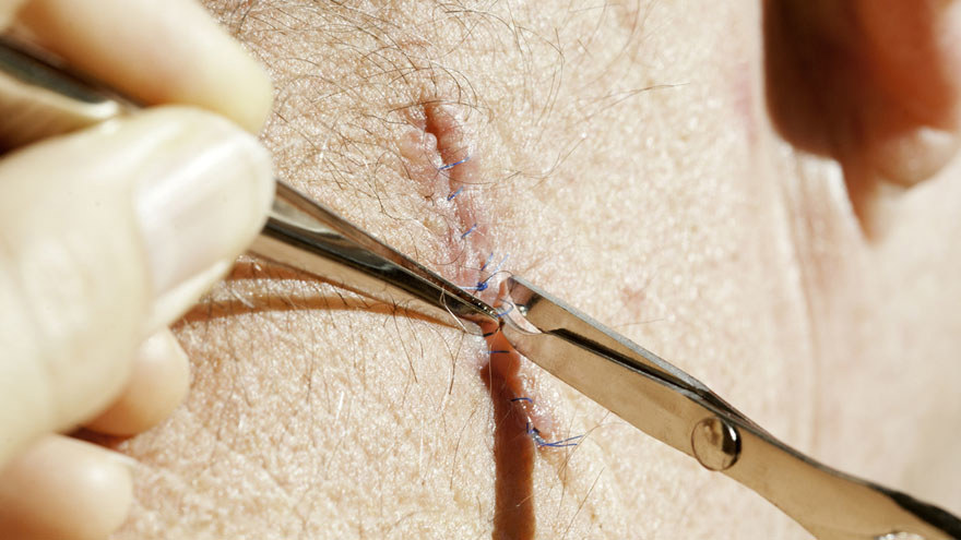 Buried Suture Removal